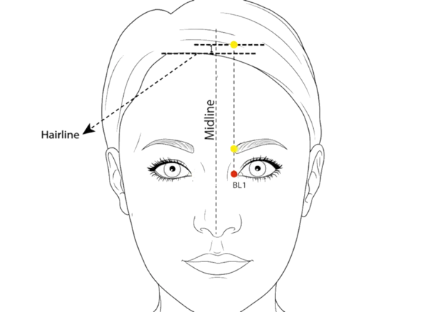 Location illustration for 0.1 cun superior to the inner canthus of the eye, near the medial orbital margin.