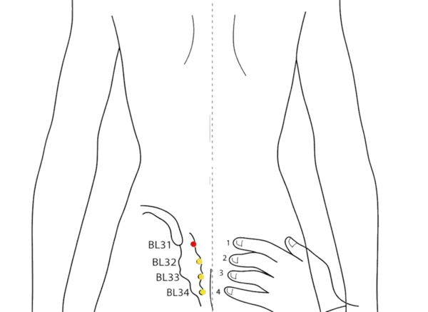 Location illustration for Over the first posterior sacral foramen (S1).