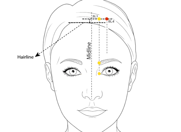 Location illustration for 0.5 cun posterior to BL-3, 1.5 cun lateral to the midline, within the anterior hairline.