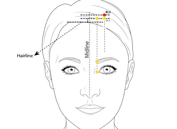 Location illustration for 0.5 cun directly posterior to BL-4, 1 cun above the anterior hairline, and 1.5 cun lateral to the midline.