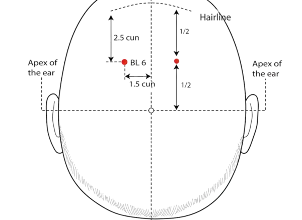 Location illustration for 2.5 cun posterior to the anterior hairline and 1.5 cun lateral to the midline, directly above BL-5.
