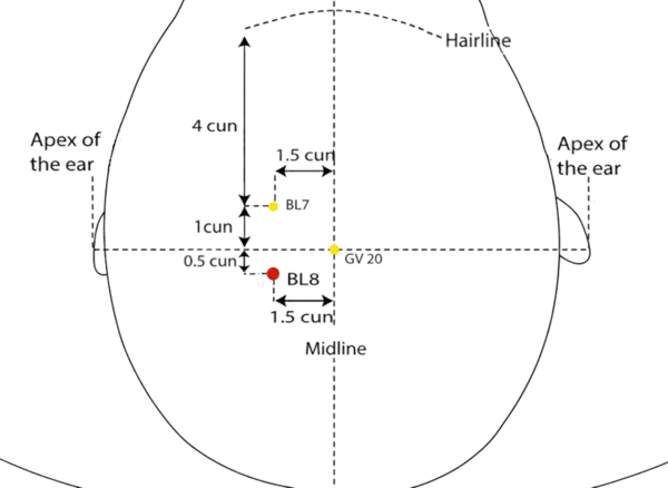 Location illustration for 5.5 cun posterior to the anterior hairline and 1.5 cun lateral to the midline, directly above BL-7.