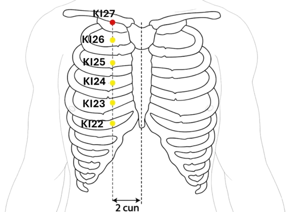 Location illustration for On the chest, just below the clavicle, lateral to the sternum.