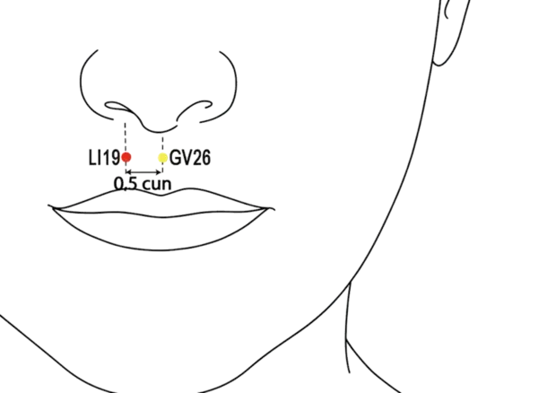 Location illustration for Located beside the nose, near the nasolabial groove.