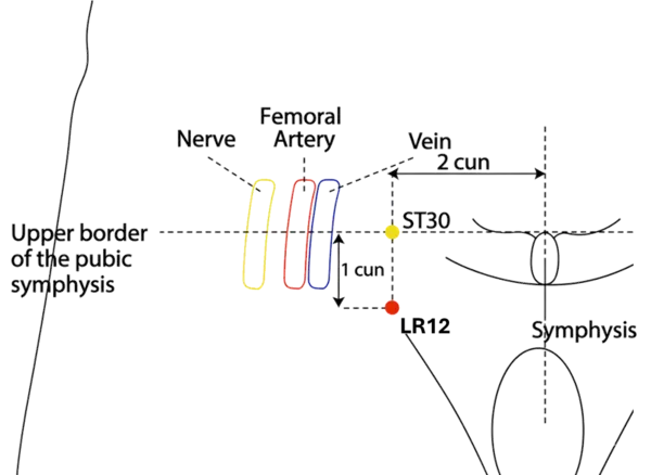 Location illustration for Located in the inguinal region, lateral to the pubic symphysis.