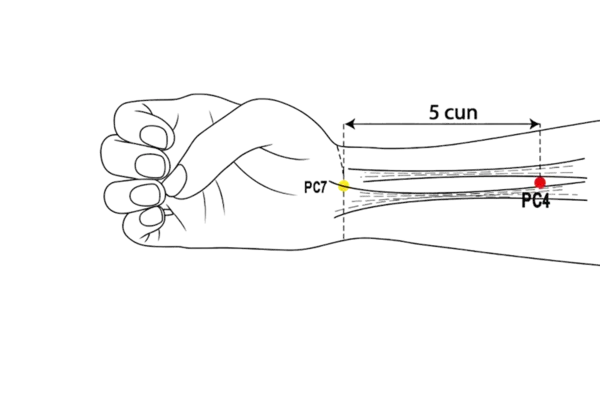 PC-4 - Xi-Cleft Gate Acupoint Location illustration for Located on the forearm, midway between the wrist and elbow.