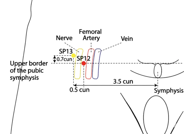 Location illustration for In the inguinal region, near the femoral triangle.